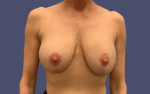 Breast Lift w/ Augmentation 9 Before